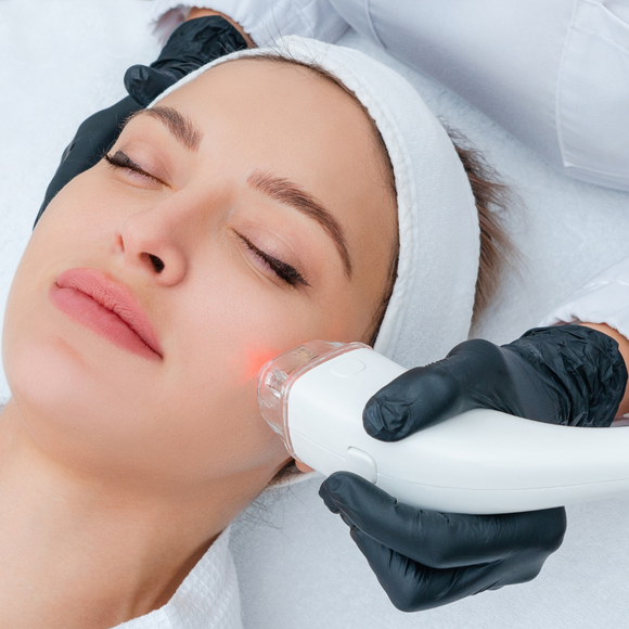 Laser Skin Resurfacing- Full Face- Package of 3 Treatments