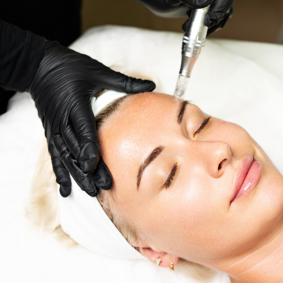 Microneedling with Exosomes